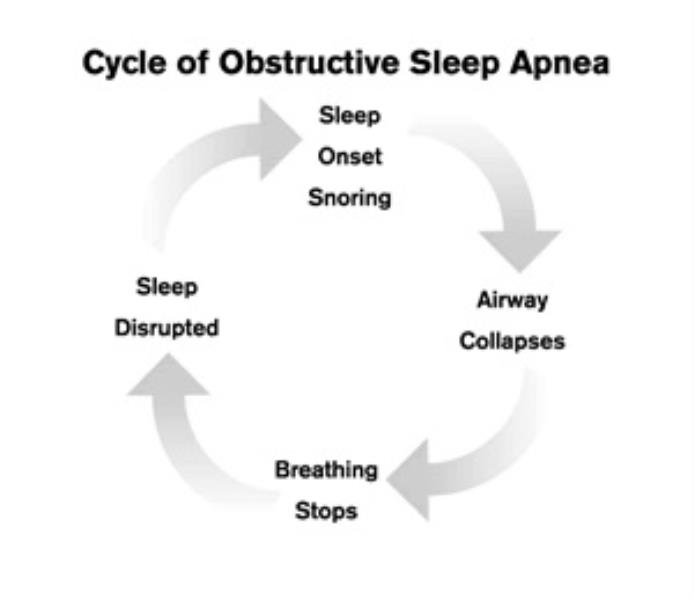 Sleep Apnea Causes and Treatment (Updated 2018)