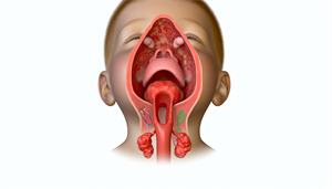 Photo of enlarged tonsils and adenoids in a child's throat