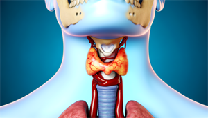 Photo of an enlarged thyroid obstructing the airway